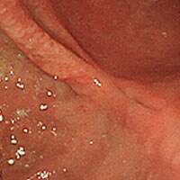 胃潰瘍瘢痕（胃潰瘍のあと） 画像01