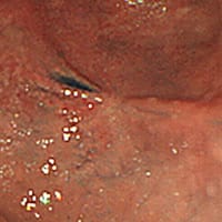 胃潰瘍瘢痕（胃潰瘍のあと） 画像02