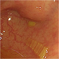 大腸ポリープ（NBI、狭帯光観察と大腸ポリープ切除） 症例写真01
