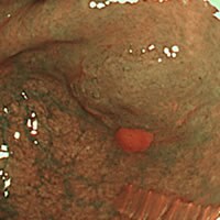 大腸ポリープ（NBI、狭帯光観察と大腸ポリープ切除） 症例写真02
