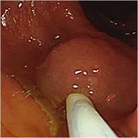 大腸ポリープ（NBI、狭帯光観察と大腸ポリープ切除） 症例写真03