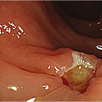 大腸ポリープ（NBI、狭帯光観察と大腸ポリープ切除） 症例写真04