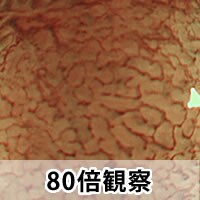 大腸ポリープ（NBI、狭帯光拡大観察） 症例写真03