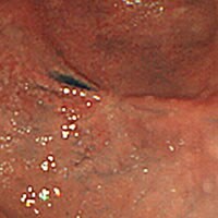 胃潰瘍瘢痕患部写真