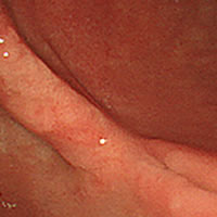 胃潰瘍瘢痕患部写真